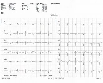 EKG mit normalem rhythmischem Sinusrhythmus